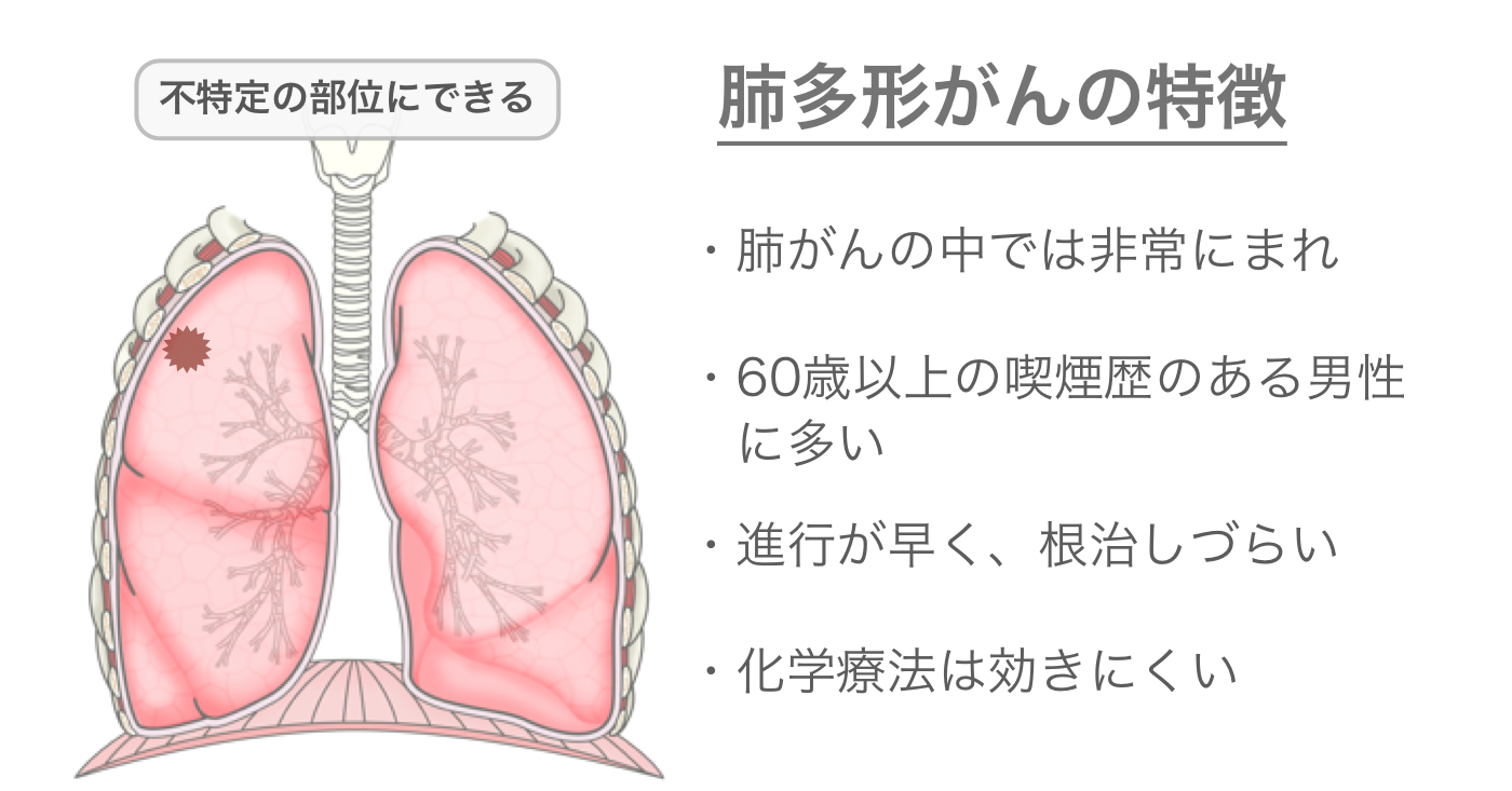 多形腺腫からの癌腫の治療選択肢は何ですか?