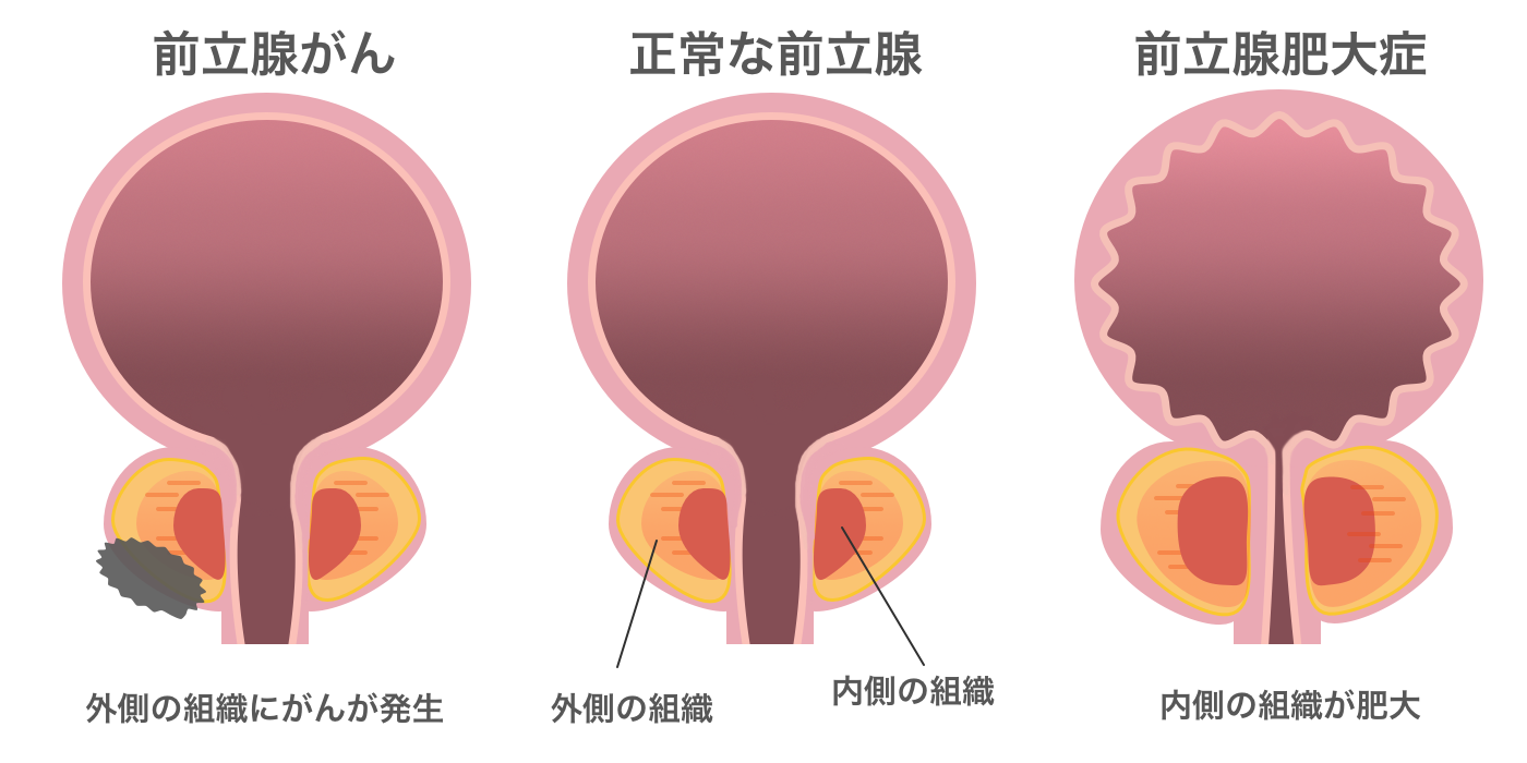 治療により勃起不全が生じることはありますか?