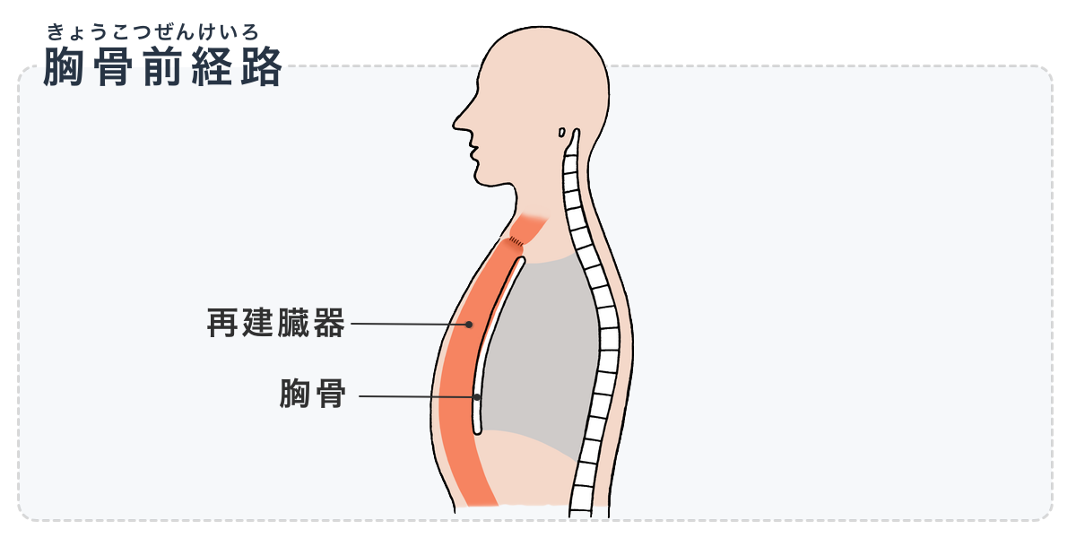 図：食道再建の胸骨前経路。