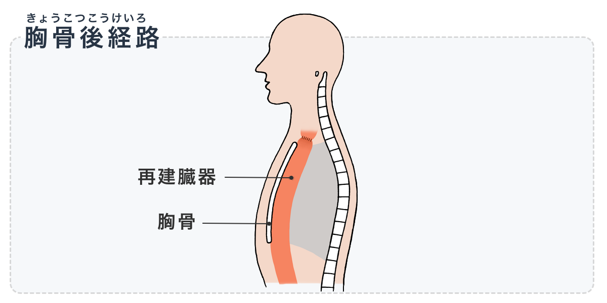 図：食道再建の胸骨後経路。