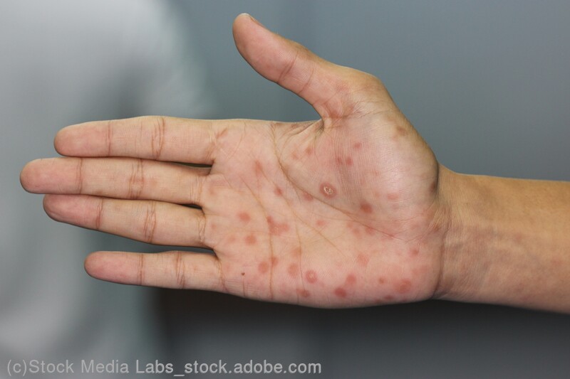 梅毒の症状：梅毒性バラ疹