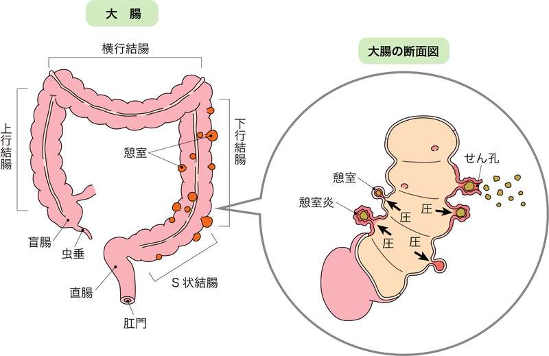憩室炎支持療法とは何ですか?