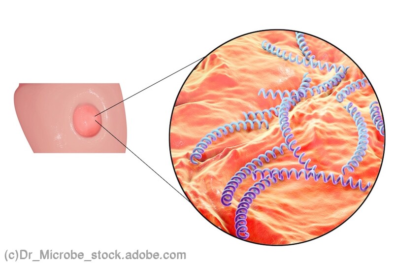 梅毒の症状：硬性下疳