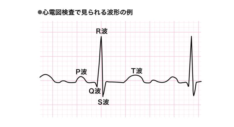 心電図検査で見られる波形,P波、Q波、R波、S波、T波