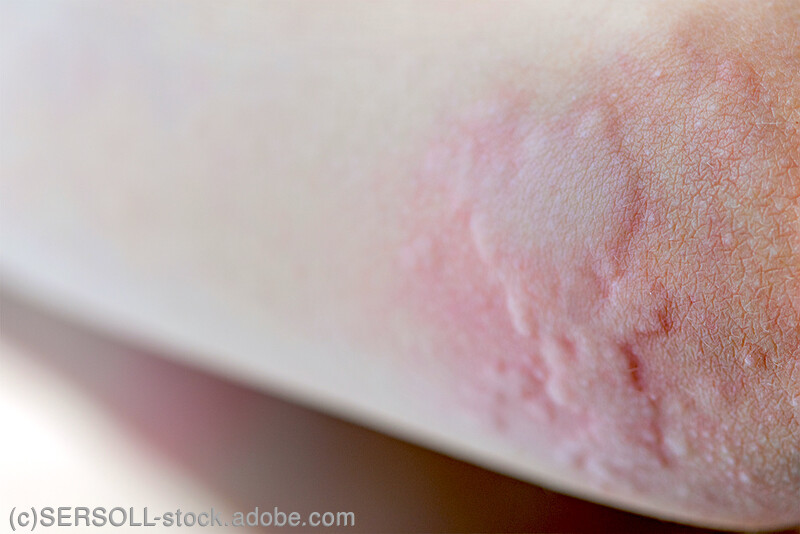 潜在的な副作用とリスク