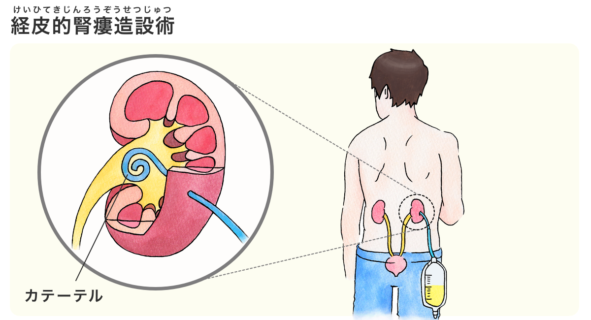 図：腎瘻を入れた様子。