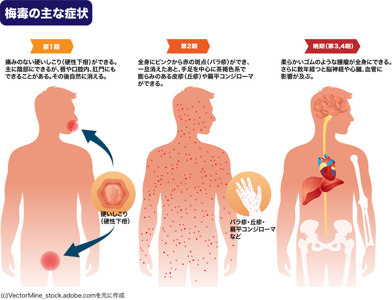 梅毒の主な症状や見た目、皮膚の症状