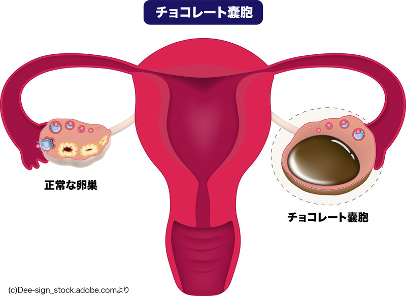 チョコレート嚢胞のイラスト