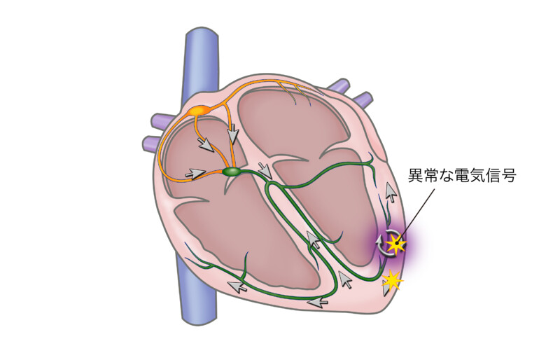 心室頻拍の模式図