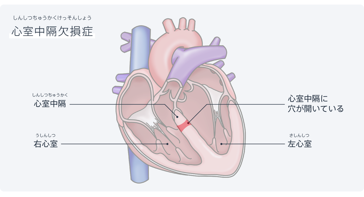 図：心室中隔欠損症は、左心室と右心室の間にある壁（心室中隔）に穴が開いている状態。