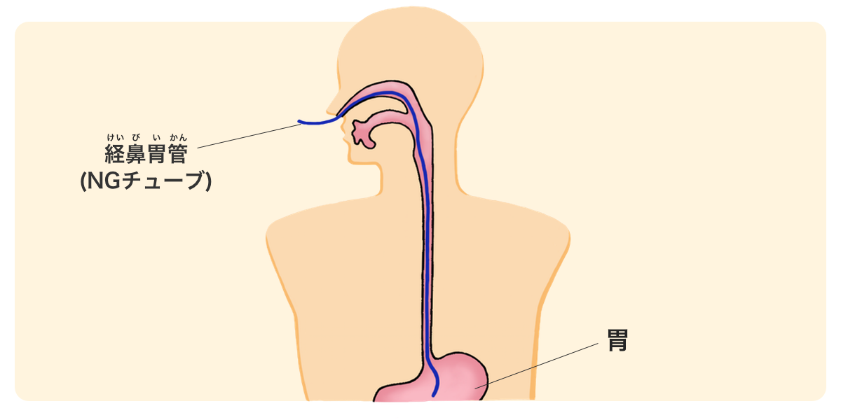 イメージ：経管栄養の図