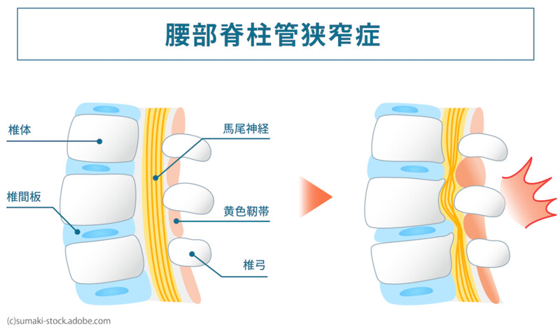 腰部脊柱管狭窄症
