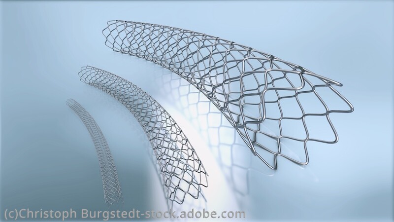 ステントのイメージ画像