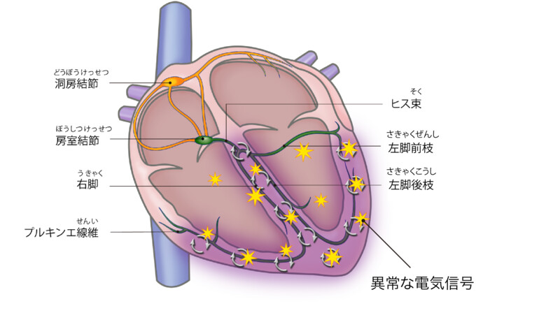 心室細動の模式図
