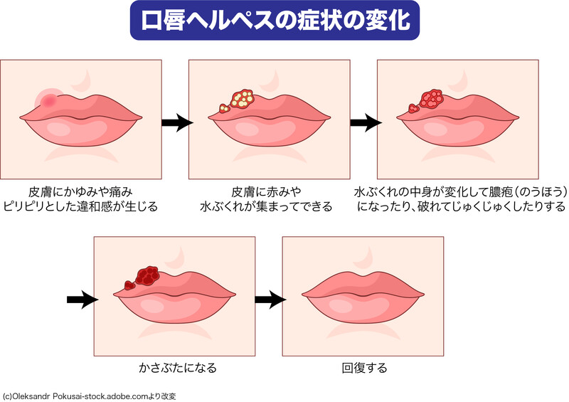 口唇ヘルペスの症状の変化のイラスト