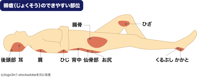 褥瘡（床ずれ）のできやすい箇所：仙骨、お尻など