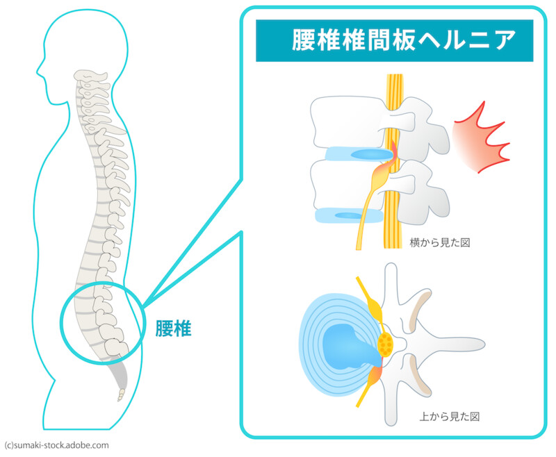 腰椎椎間板ヘルニア