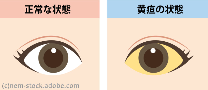 黄疸の症状