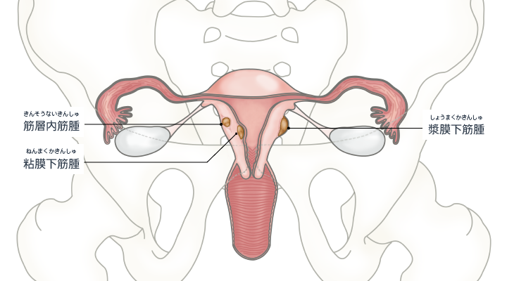 子宮筋腫の場所による分類のイラスト。粘膜下筋腫、筋層内筋腫、漿膜下筋腫に分類できる。