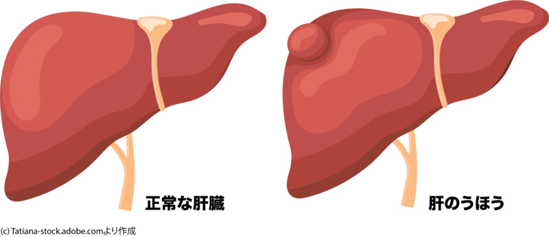 肝のうほうのイメージ