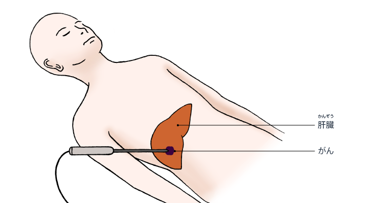 肝臓の焼灼療法