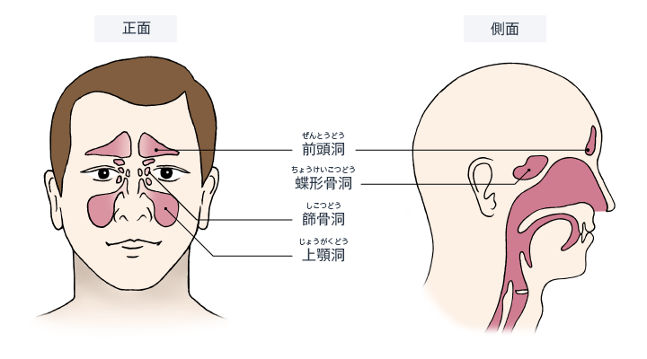 副鼻腔炎の頭痛の症状は何ですか?