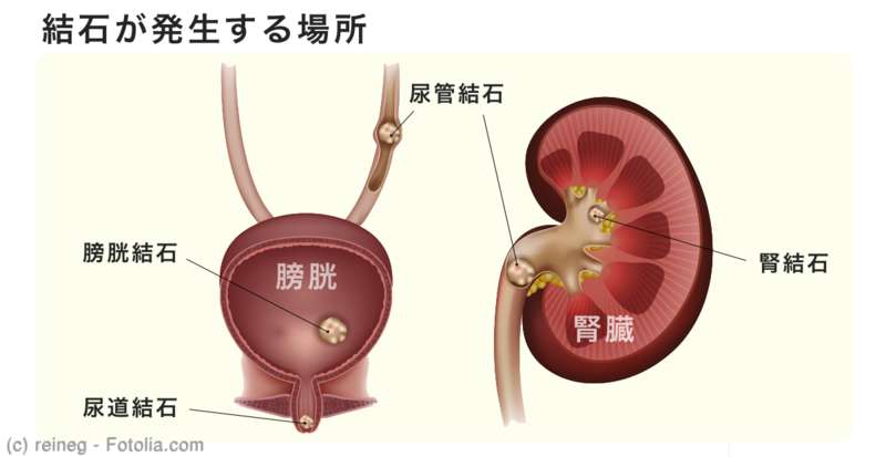 結石が発生する場所