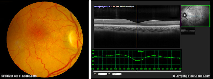 眼底検査と光干渉断層計（OCT）検査