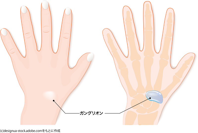 手首にできたガングリオンのイラスト