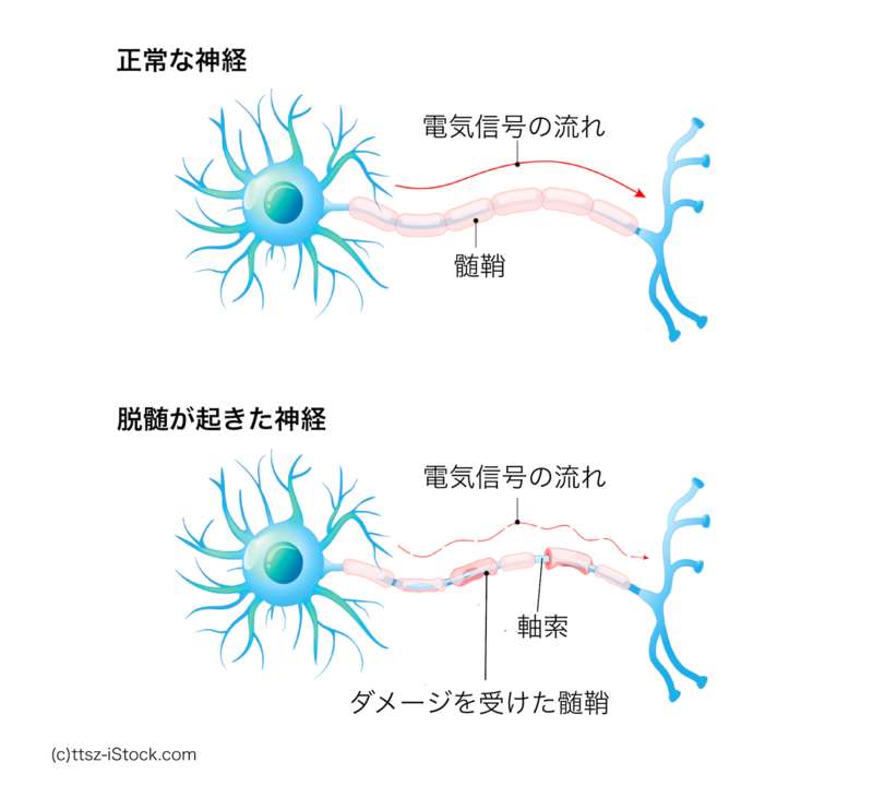 脱髄が起きた神経