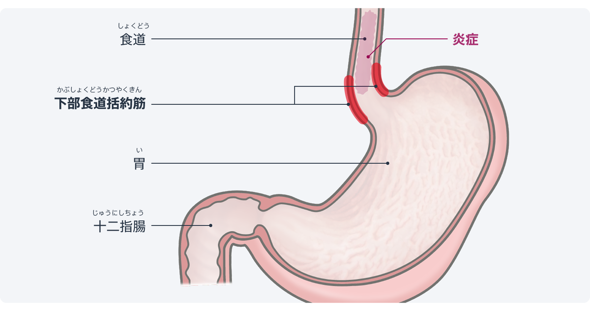 成人の胃食道逆流症の症状は何ですか?