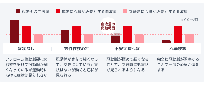 図：狭心症の症状は冠動脈の血液量が心臓に必要な血液量を下回った時に現れる。