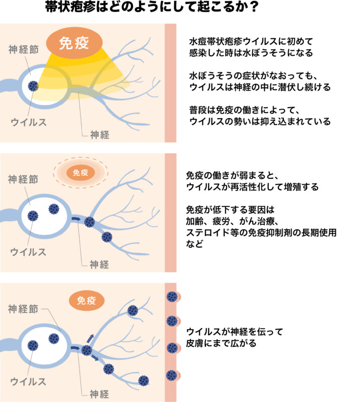 帯状疱疹が起こるメカニズム