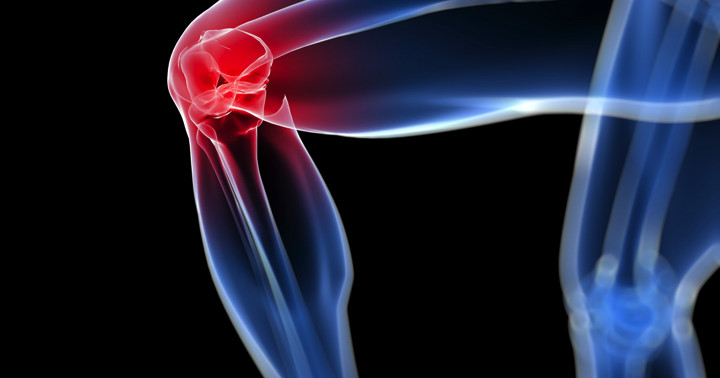 変形性膝関節症による軟骨のダメージを防げるか?関節離開術と外固定の試みの写真