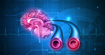 脳梗塞の救急治療で、血管内治療は有効か？の写真