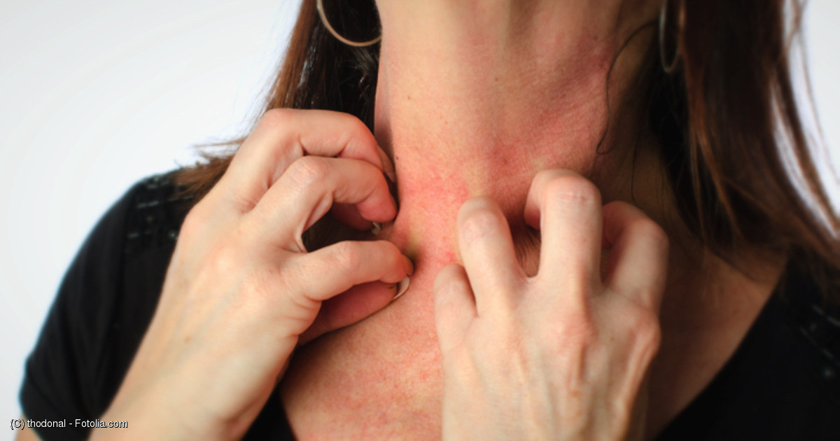 薬による発疹 後遺症も スティーブンス ジョンソン症候群と中毒性表皮壊死症患者のその後 Medleyニュース