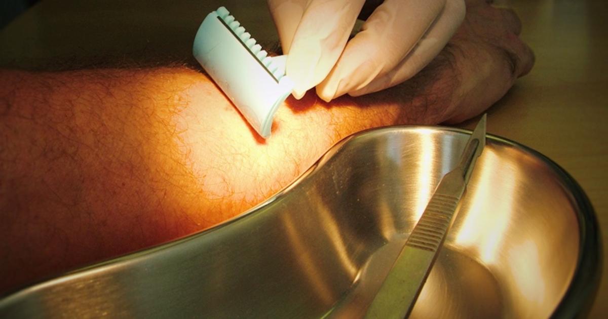 本当に剃らなきゃダメ 手術前に毛を剃る本当の理由 Medleyニュース