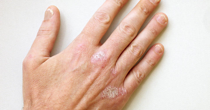 膝の乾癬の症状